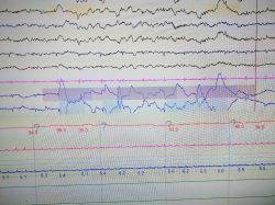 Polysomnography readout, results of sleep testing in Melbourne